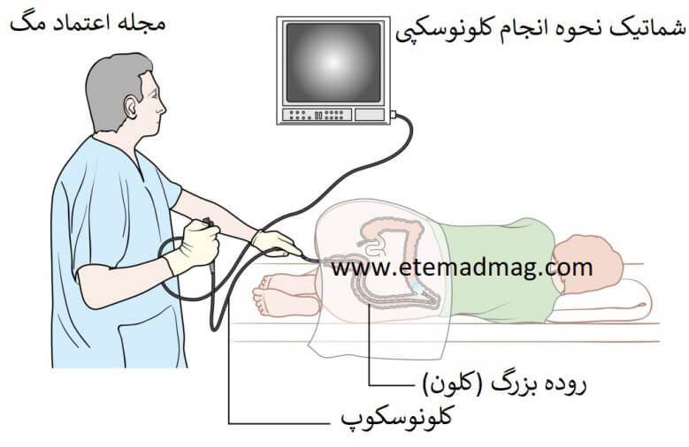 نحوه انجام کولونوسکوپی colonoscopy