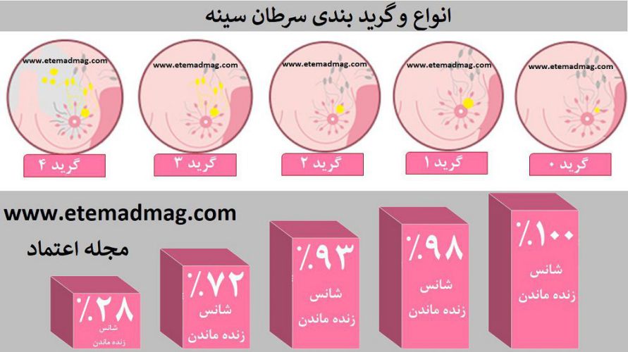 گرید سرطان سینه و احتمال زنده ماندن