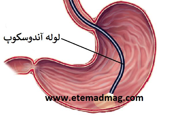 عوارض آندوسکوپی